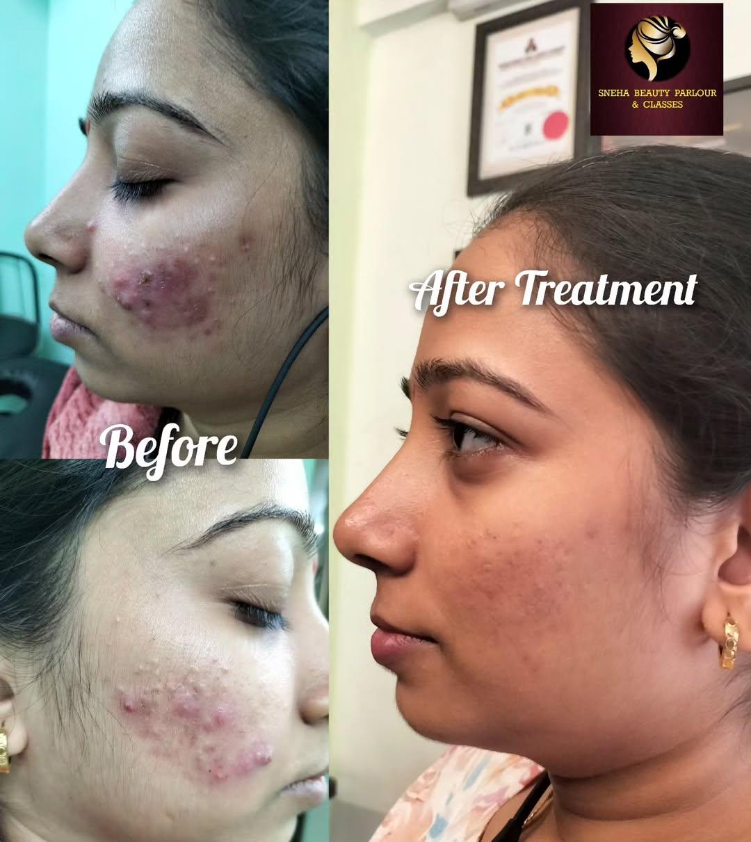 Skin services at Sneha Beauty Parlour in Kalyan East